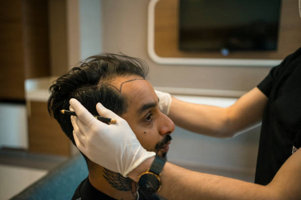 Hair Transplant in Riyadh