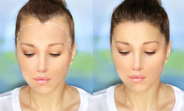 Hair transplant in Dubai